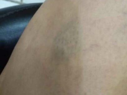 Marks From Cesar Gebara's Abuse